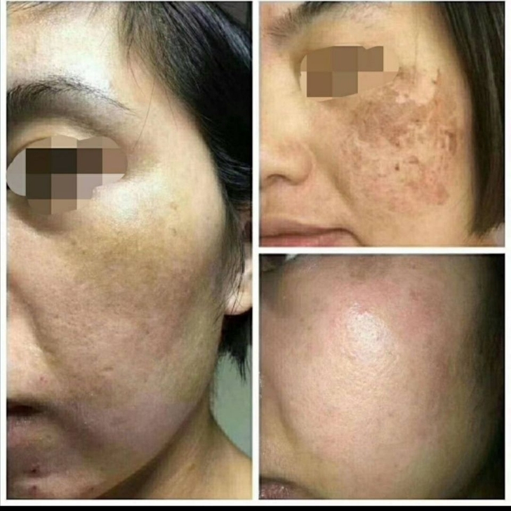 两秒橡皮擦祛斑2秒祛班生物酶提取液药水点斑...