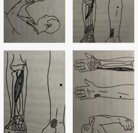 很多创伤或事故后会十分容易激活一些相关的触...